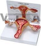 Female Uterus Anatomy Model showing common pathologies